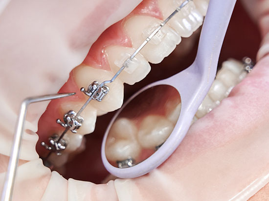 ¿Cuanto cuesta ponerse Brackets?