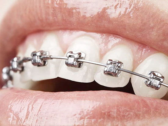 Cuidado del sistema de brackets de autoligado