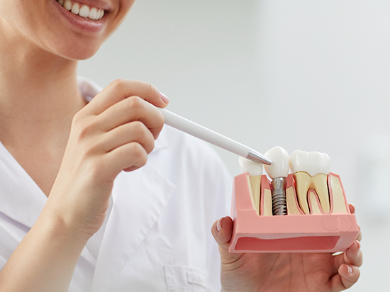 ¿Por qué se coloca un implante dental?