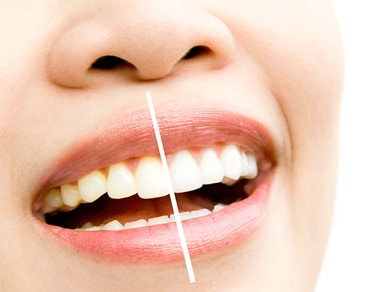 Cuidado del sistema de brackets de autoligado