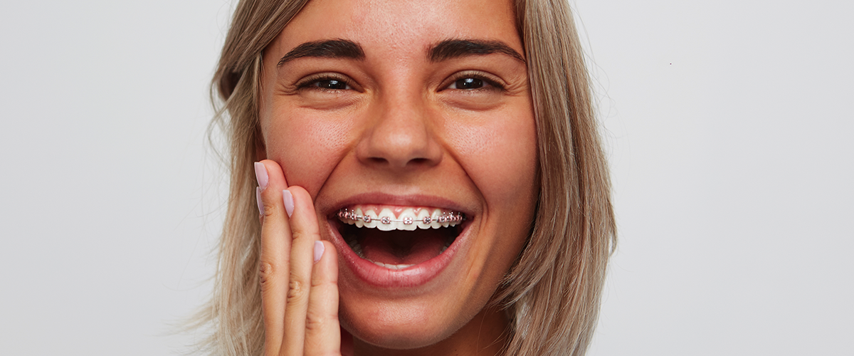 Brackets: Sistema Autoligado