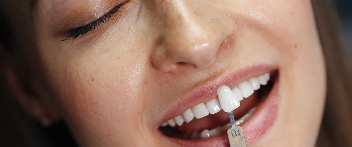 ¿Cómo cuidar las carillas dentales?