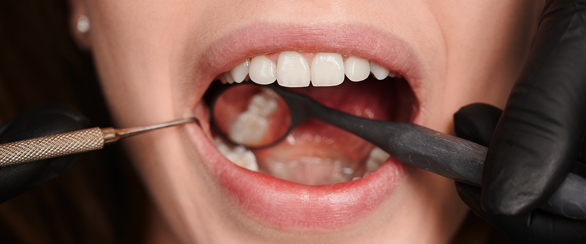 ¿Cuál es el tercer molar?