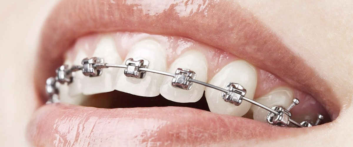 Cuidado del sistema de brackets de autoligado