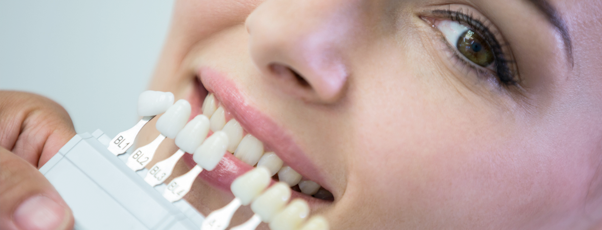 Lo que debes saber antes de realizarte un blanqueamiento dental