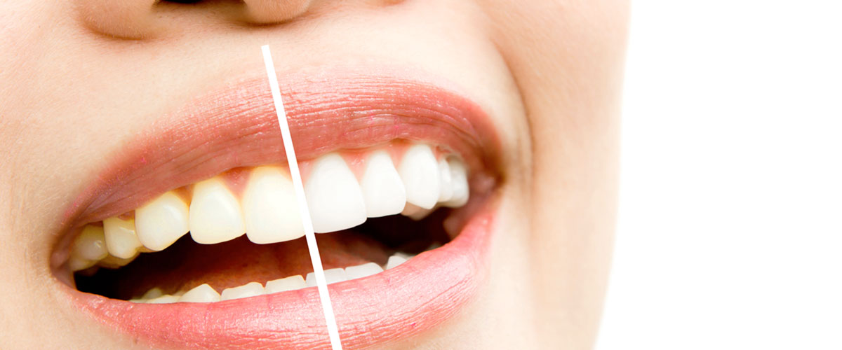 ¿Qué esperar del blanqueamiento dental?