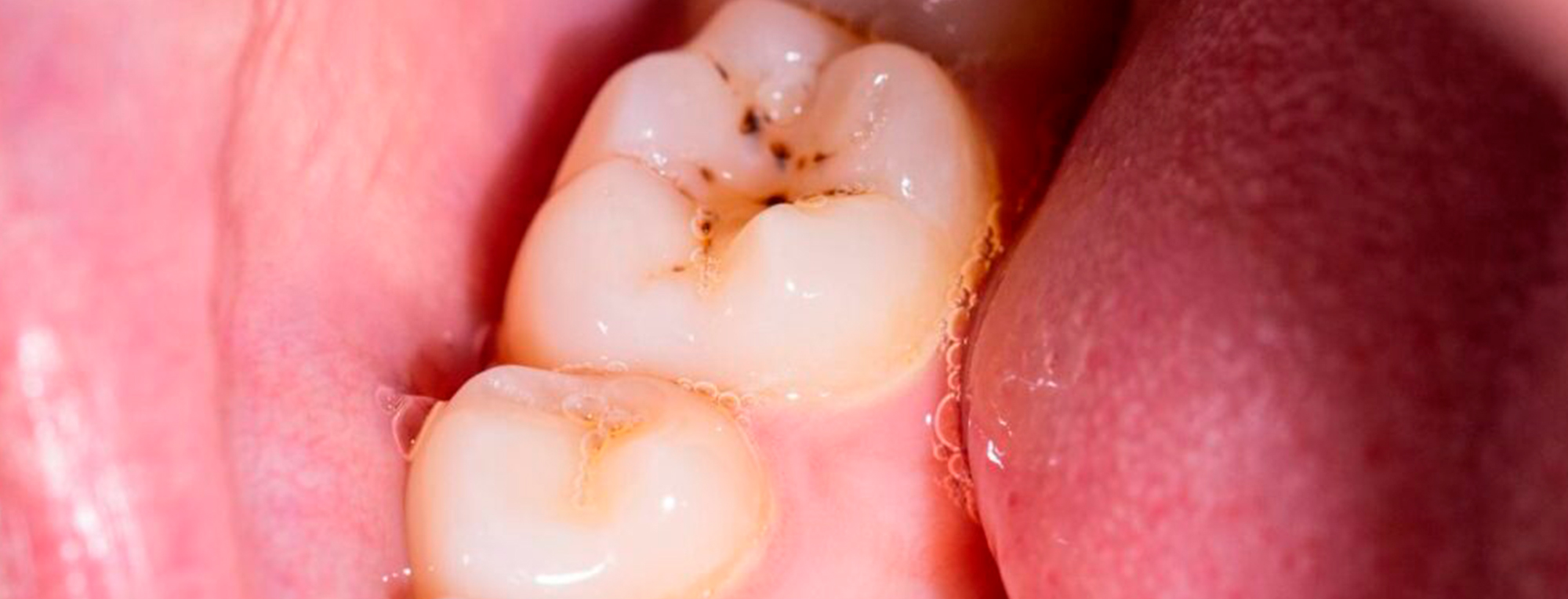 Tipos de caries dentales: cómo se desarrollan y cuáles son sus tratamientos